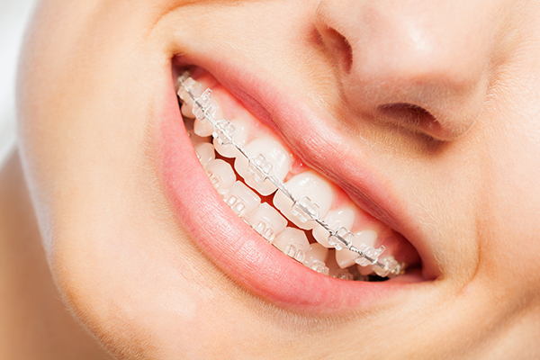Clear Braces in Jackson Heights