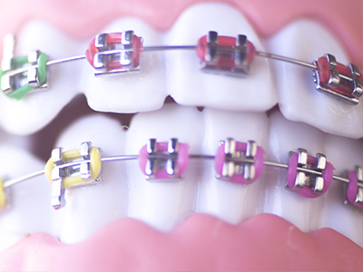 Jckson Heights Traditional Metal Braces
